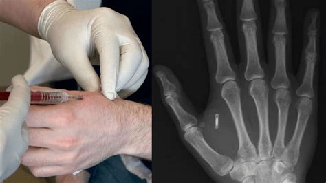 hand rfid chip|rfid implants in the hand.